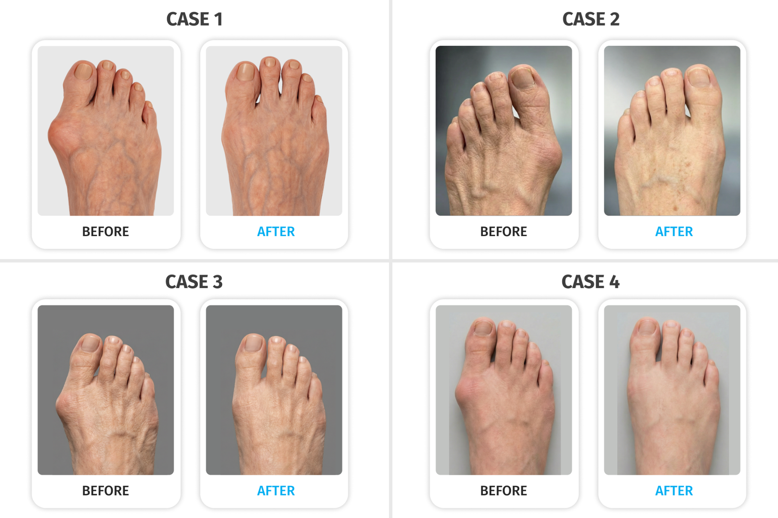 VEONESS Bunion Fix