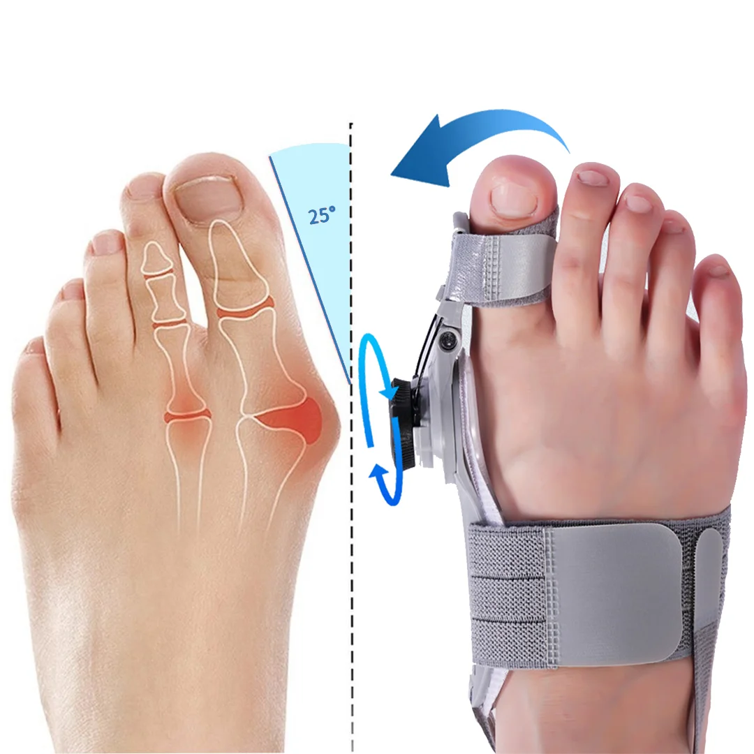 Bunion before and after VEONESS Bunion Fix